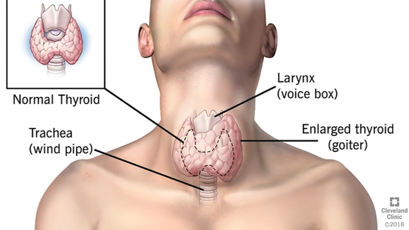 Thyroid