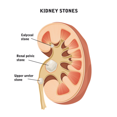 Kidney Stones